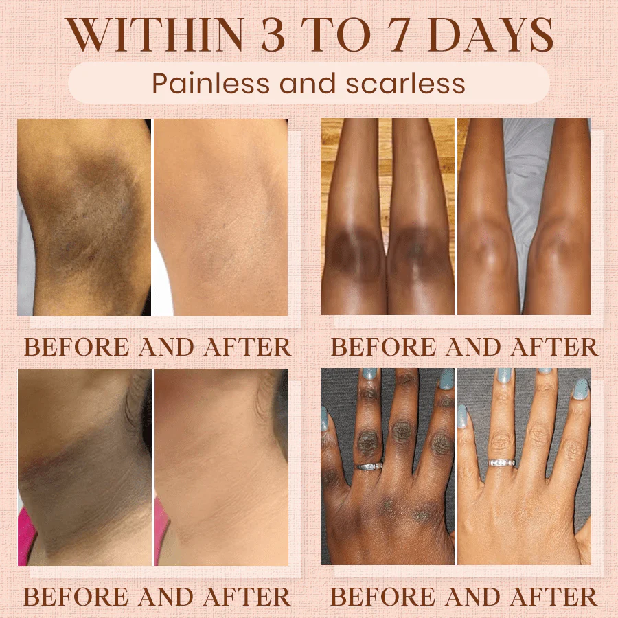 Luhaka® Purifying Exfoliating Gel for Acanthosis Nigricans, Exfoliation, Dark Spots, Skin Tags, and Eczema 🎉