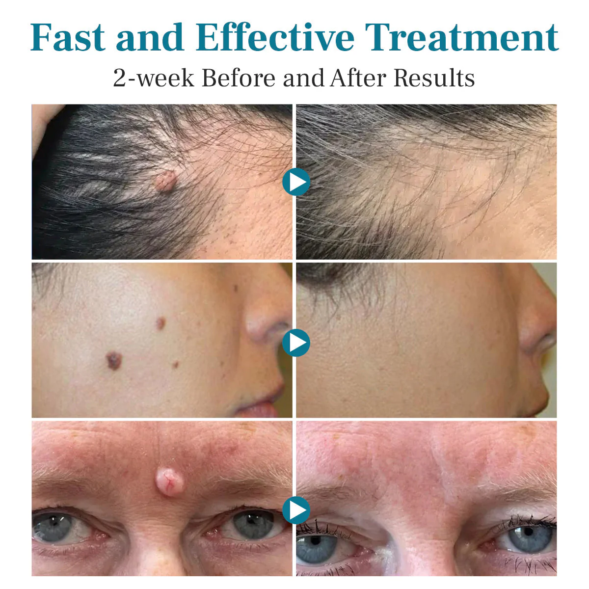 DAFEILA® LumeSkin Mole and Wart Removal Laser Pen_Ultra01